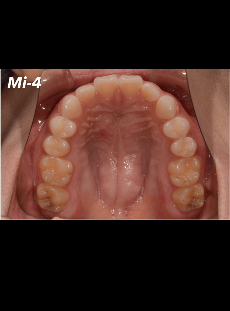 taro Sony α65 口腔内写真撮影セット 10万円以下で揃える口腔内写真カメラセット